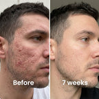 Next-Generation Acne Scar Stick