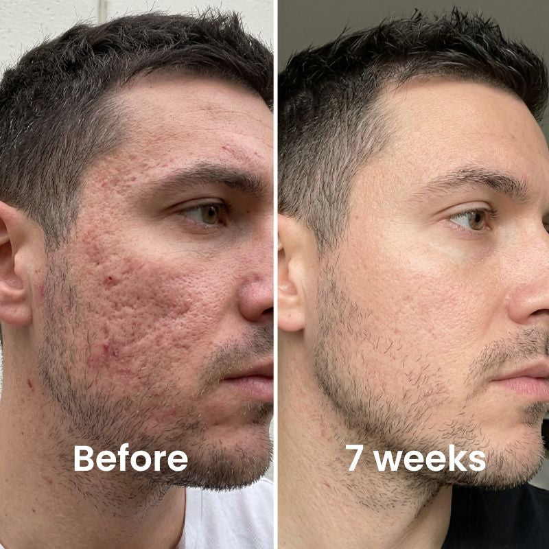 Next-Generation Acne Scar Stick