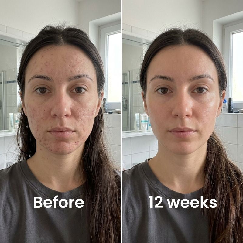 Next-Generation Acne Scar Stick